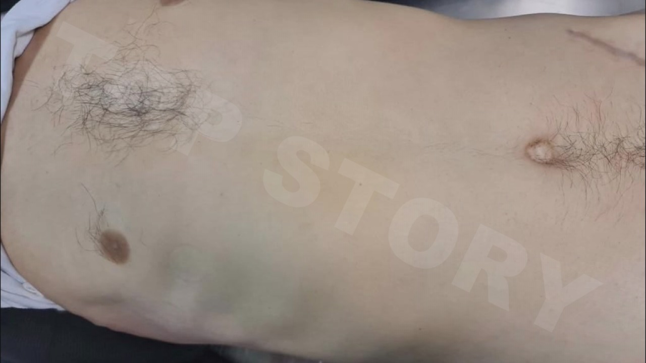 Publikohen fotot e trupit të Ilvi Metës, pasi kishte humbur jetën me shenja në brinjë
